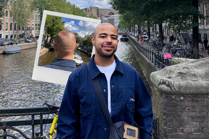 Every Single Thing That Happened During My Hair Transplant